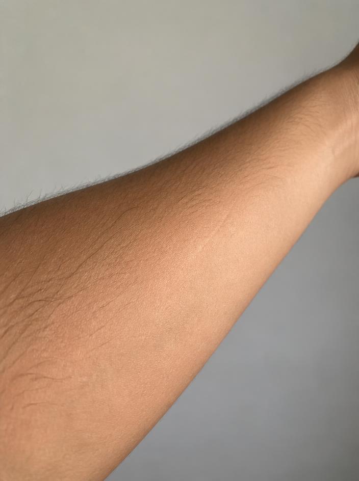 The same forearm nine weeks later with the scar flatter and much paler