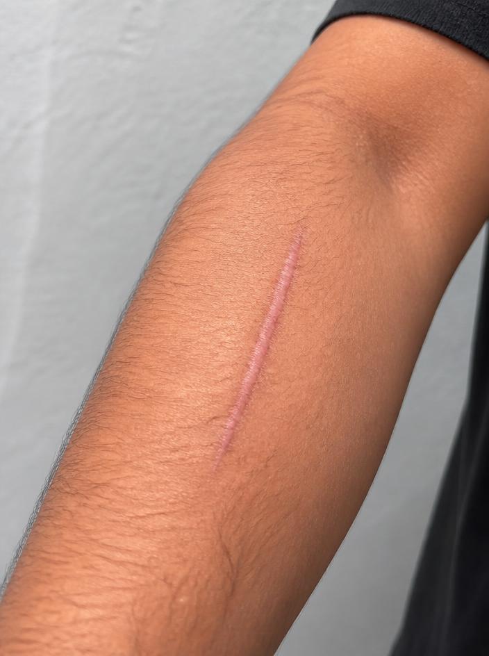 A man's forearm with a raised pink healing scar early in recovery